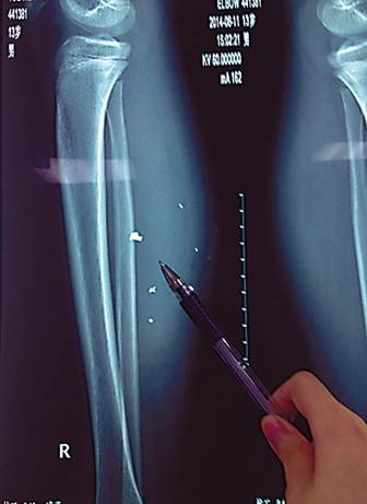 男孩充電時(shí)玩游戲 手機(jī)爆炸致異物進(jìn)入小腿